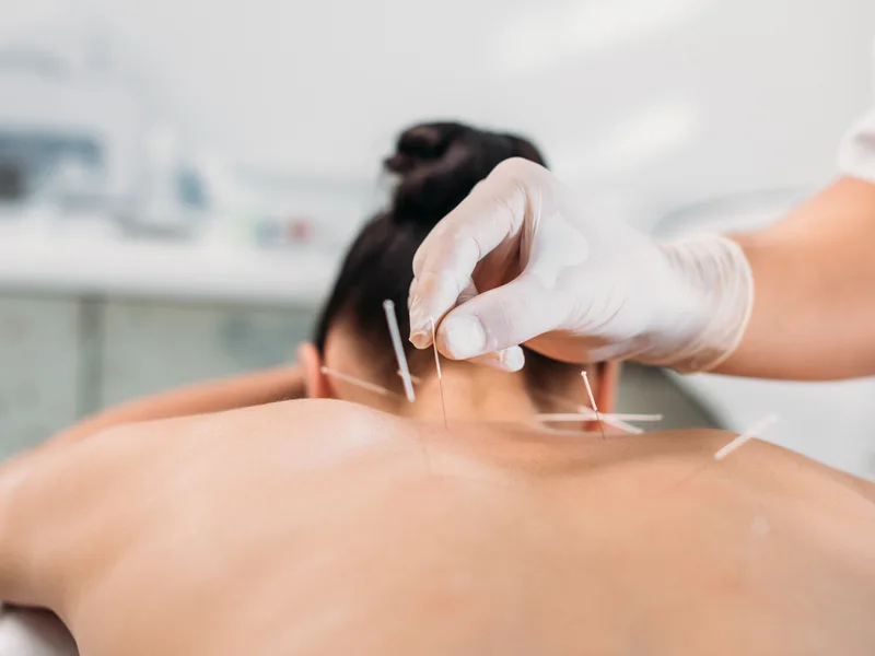 Dry Needling at Locke Chiropractic & Rehabilitation Center in Winston-Salem